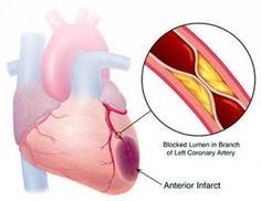 Comment traiter l'infarctus du myocarde à la maison avec des remèdes populaires?