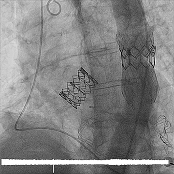 Sténose de la valve aortique: qu'est-ce que c'est, comment la traiter et vaut-il la peine d'avoir peur