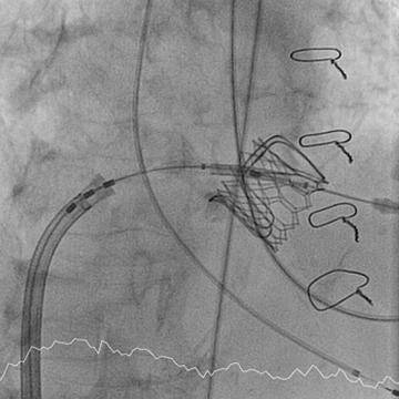 Stenosis katup aorta: apa itu, bagaimana mengobatinya, dan apakah itu layak untuk ditakuti