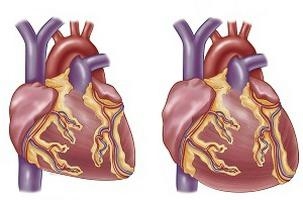Kardiopatie u dospělých - co to je?
