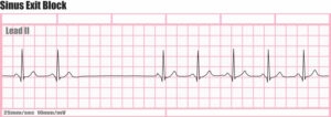 EKG'de angina pektoris kendini nasıl gösterir?