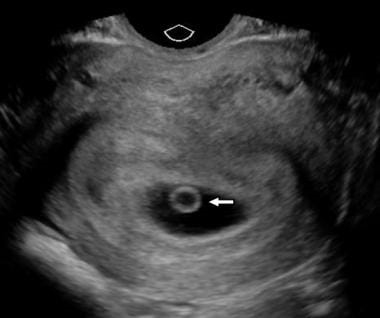 Kenmerken van het verloop van VSD tijdens de zwangerschap
