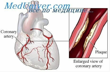 Komplikacijos po miokardo infarkto: kaip išvengti ir užkirsti kelią
