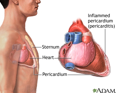 Hvad skal man gøre, hvis der er væske i hjertesækken