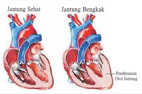 Gejala patologi jantung pada wanita