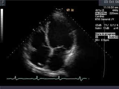 Qu'est-ce que la cardiomyopathie dysmétabolique