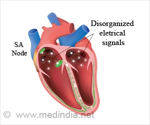 Causes, symptoms, ECG diagnosis and treatment of sinus bradycardia
