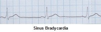 Sinüs bradikardisinin nedenleri, semptomları, EKG tanı ve tedavisi