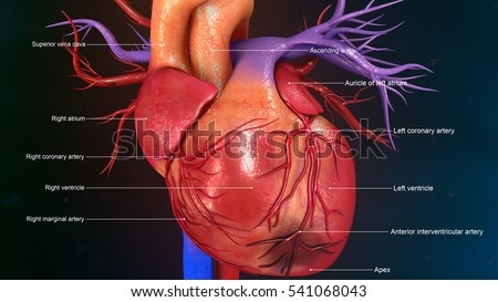Large focal myocardial infarction
