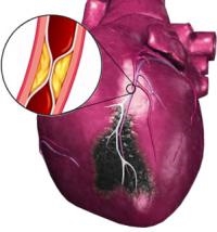 Pienen fokaalisen sydäninfarktin kliininen kuva ja hoito