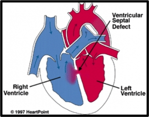 Klinika VSD w fazie zaostrzenia