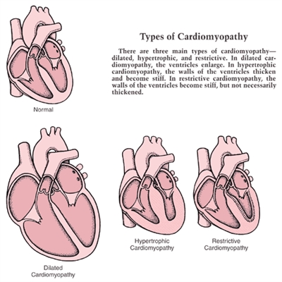 Restriktiivse kardiomüopaatia sümptomid ja ravi