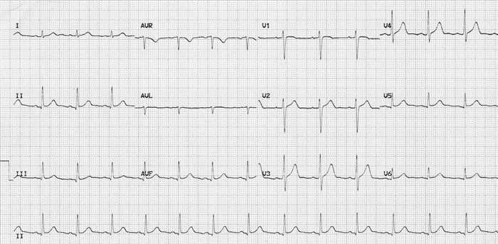 Hogyan lehet felismerni a hasi szívinfarktust és mi a teendő?