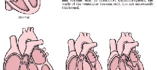Secondary cardiomyopathy - symptoms, clinical picture and treatment.