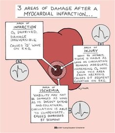 Symptomer, EKG-tegn og behandling af inferior infarkt