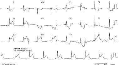Symptomen, ECG-tekens en behandeling van inferieur infarct