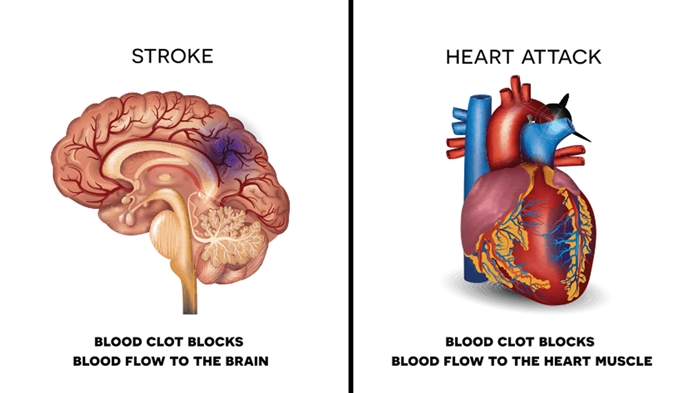 Infarto e ictus: somiglianze e differenze