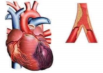 Diagnostic de l'infarctus aigu du myocarde