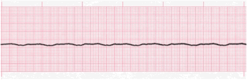 Apakah asystole?