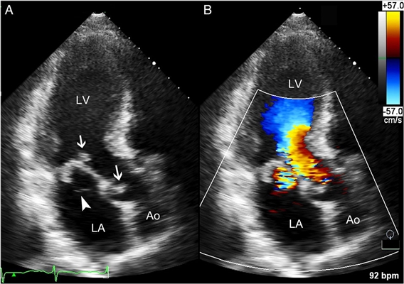 ทั้งหมดเกี่ยวกับ Mitral Valve: กายวิภาคศาสตร์ สรีรวิทยา และโรค