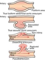 Tutto sulla dissezione dell'aneurisma aortico