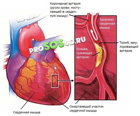 Характеристики, лечение и последици от инфаркт на задната стена на сърцето