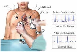 Kardioverzija za fibrilaciju atrija (atrijalna fibrilacija)