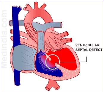 Simptomele, diagnosticul și tratamentul tahicardiei ventriculare