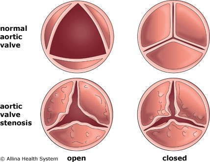 Aorta szívhibák: típusok és tünetek auskultáción