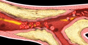 Pembedahan untuk infark miokard pada jantung - kapan dan bagaimana melakukannya?
