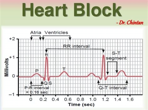 Descrierea, tipurile, simptomele, diagnosticul și tratamentul blocului cardiac