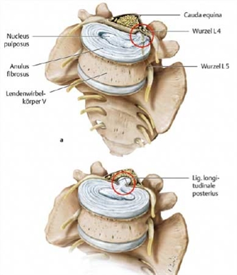 Kann bei Osteochondrose eine Extrasystole auftreten?