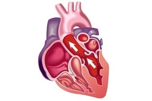 Sintomas típicos de doença cardíaca