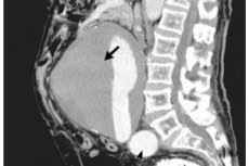 Aortan aneurysma: kuvaus, diagnoosi ja hoito