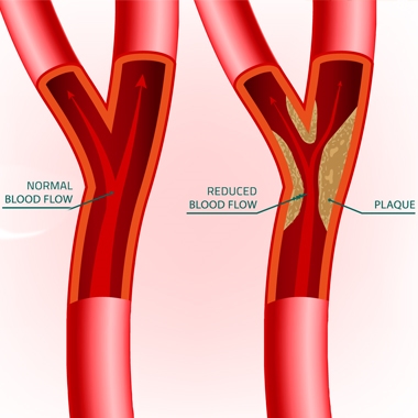 Miega artēriju un citu kakla asinsvadu aterosklerozes simptomi un ārstēšana