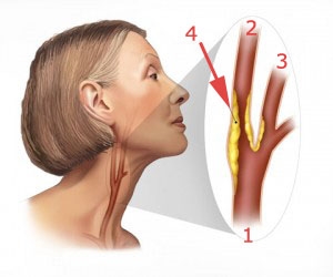 Symptomen en behandeling van atherosclerose van de halsslagaders en andere halsslagaders