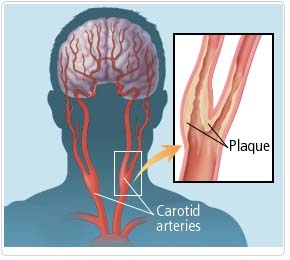 Sintomas e tratamento da aterosclerose das artérias carótidas e outros vasos do pescoço