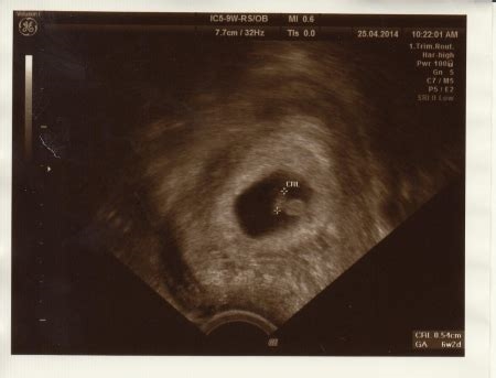 Ultrazvuk srdce plodu během těhotenství