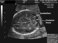 Ultrasound of the fetal heart during pregnancy