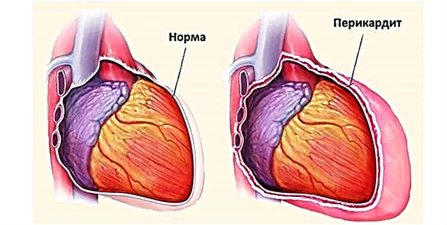 Αιτίες και θεραπεία της εξιδρωματικής περικαρδίτιδας: τι να κάνετε με το υγρό στην καρδιά
