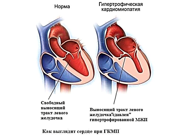 Penyebab, gejala dan pengobatan kardiomiopati hipertrofik