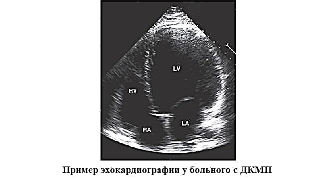 Symptoms, diagnosis, prognosis and causes of death in dilated cardiomyopathy