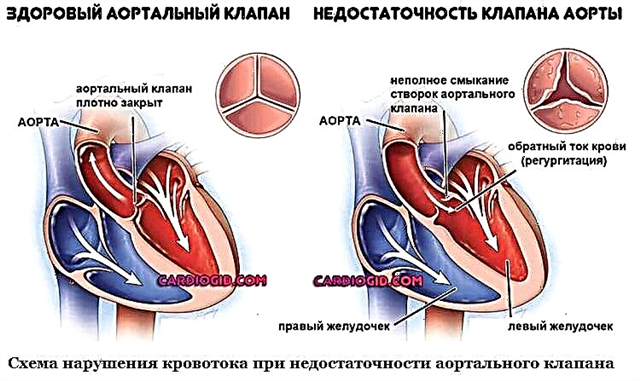 Шта је инсуфицијенција аортног вентила и како се лечити