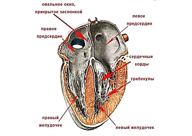 False chord of the left ventricle of the heart: how to act