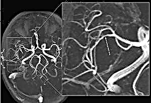 Como se manifesta a aterosclerose dos vasos cerebrais e como é tratada: síndromes, diagnósticos, medicamentos