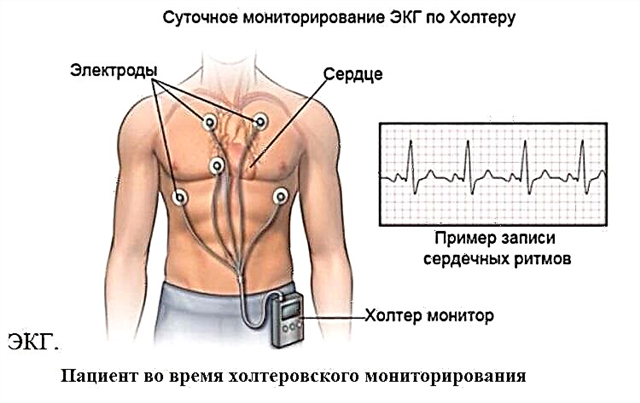 Causes, symptoms and treatment of bradycardia: what is its danger
