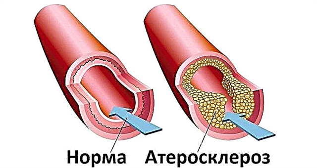 Which doctor to contact with atherosclerosis