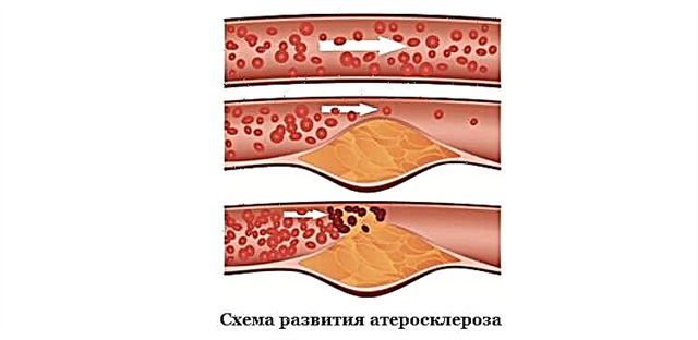 Varför det uppstår och hur man behandlar ateroskleros i kranskärlen