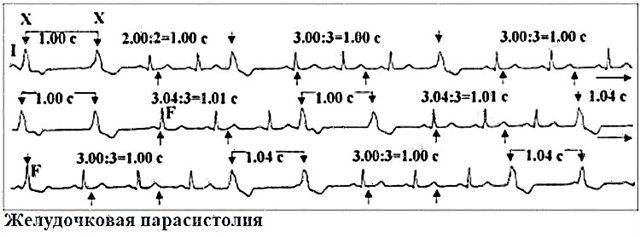 What is parasystole and how it manifests itself on the ECG