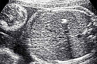 Di ventrikel kiri janin, fokus hyperechoic: apa itu, apa alasannya dan bagaimana bertindak